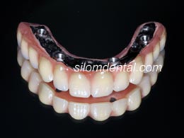 all on 4 teeth by Silom Dental Building