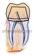 root canal treatment (Endodontics) procedure