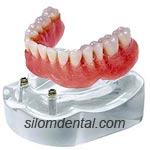2 Implants + locator abument + Overdenture in Dental Bangkok, Thailand