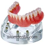 4 Implants + locator abutment + Overdenture in Dental Bangkok, Thailand