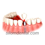 1 Implant & 1 Crown in Dental Bangkok, Thailand