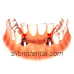 Dental Implants support Dental Bridges