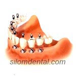 6 Implants + 12 unit Bridges in Dental Bangkok, Thailand
