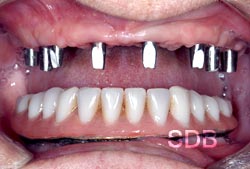 upper 8 Implants and lower implants + overdenture