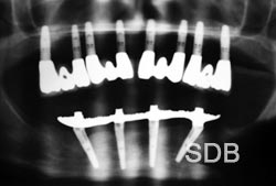 Dental Implant x-ray for full upper/lower implants replacement