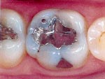 Before Dental Inlay