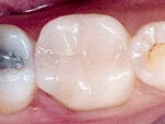 After Dental Inlay