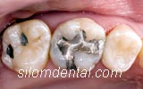 Before Dental Inlay