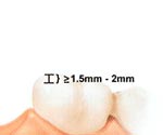 Procera Bridge tooth preparation