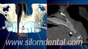 Nobel Guide 3D planning for Implants