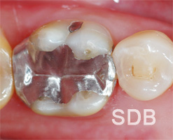 after amalgam filling