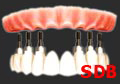 dental implant teeth in an hour Bangkok