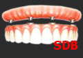 dental implant teeth in an hour Thailand