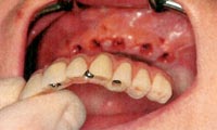 Teeth-in-an-Hour treatment