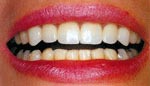 After Dental Veneer, Veneer or Facing Dental Bangkok Thailand