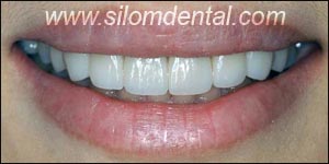After Porcelain Veneers, Veneers Dental Clinic Thailand