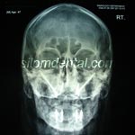 Zygoma Implant and All-on-4 case at Silom Dental Building Clinic
