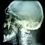 Zygoma Implant and All-on-4 case at Silom Dental Building Clinic