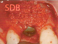 Geistlich Bio-Gide is mixed with blood and introduced to the defect