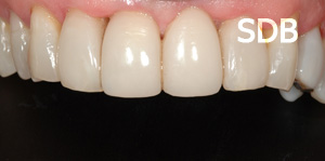 after composite facing