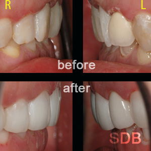 before-after composite facing