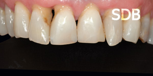 before composite facing