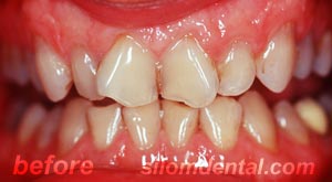 Before Dental Extreme Makeovers thailand