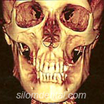 ct scan iluma for dental implant and orthodontic