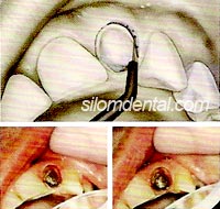 เครื่องตัดแต่งเนื้อเยื่อ Tissue Contouring