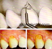 เครื่องตัดแต่งเนื้อเยื่อ Tissue Contouring