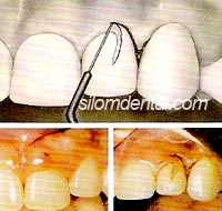 เครื่องตัดแต่งเนื้อเยื่อ Tissue Contouring