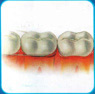 The image “http://www.silomdental.com/dental_thai/dental_tips/pic/oa10.JPG” cannot be displayed, because it contains errors.