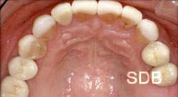 extra oral after full mouth rehabilitation