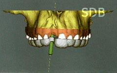 SimPlant Tooth support SurgiGuide