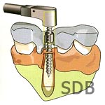 Tooth support SurgiGuide