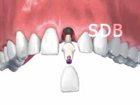 Insertion Straumann Anatomic Abutment