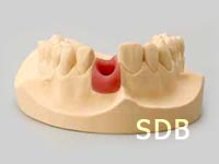 straumann anatomic abutment - wax up