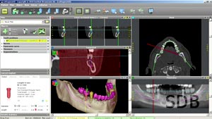 straumann guided surgery