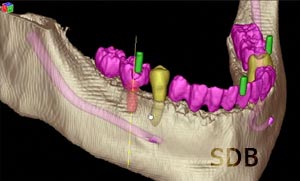 straumann guided surgery