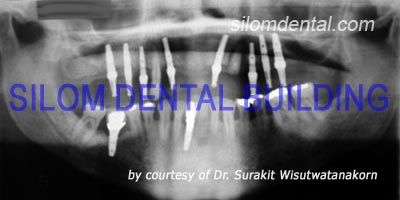 Dental Implants support bridge