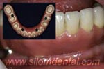 titanium porcelain and Procera Crowns