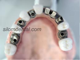 Upper All-on-4 Titanium Framework + Zirconia Crowns by Silom Dental Building