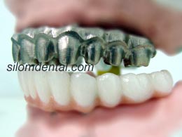 Upper All-on-4 Titanium Framework + Lower All-on-4 Zirconia Framework by Silom Dental Building