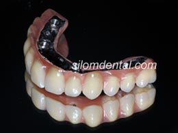 all on 4 teeth by Silom Dental Building