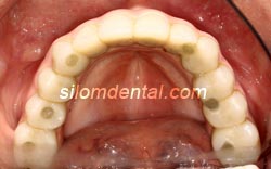 all on 6 Titanium Procera Implant Bridge