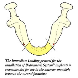 Anterior mandible