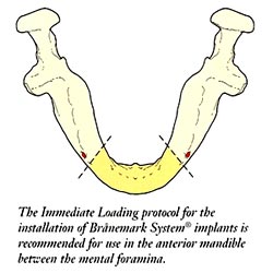 Anterior mandible