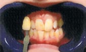 BriteSmile step1