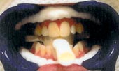 BriteSmile step1