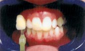 BriteSmile step1